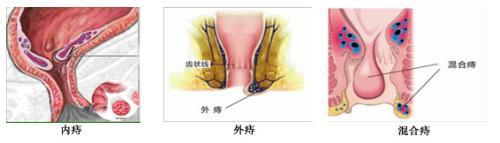 内痔外痔混合痔2.jpg