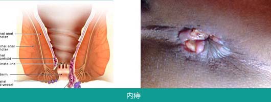 内痔 .jpg