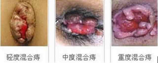 混合痔10东大.jpg