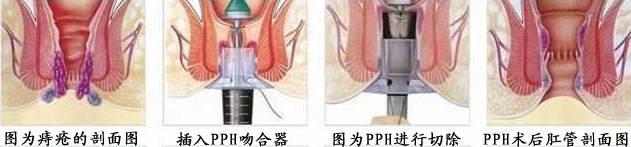 PPH手术过程.jpg