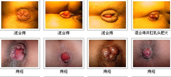 痔疮是怎么引起的
