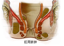 肛周脓肿.jpg