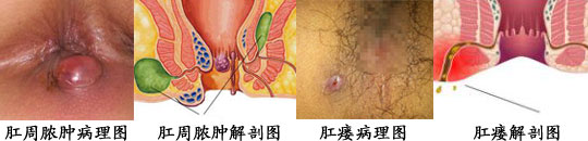 肛周脓肿、肛瘘.jpg