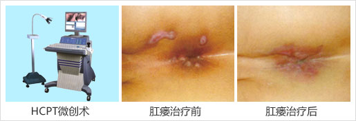 hcpt治肛瘘.jpg