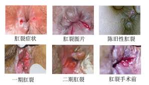 肛裂症状123期.jpg