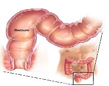 直肠炎症状及治疗