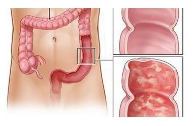 直肠炎不治会不会自愈