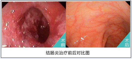 结肠炎术前术后.jpg
