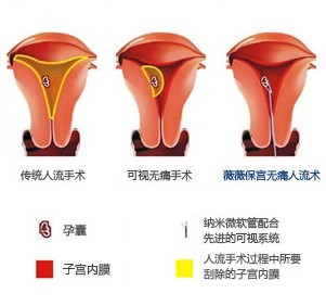 人流手术对比图.jpg